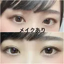 二重切開 / 上まぶたたるみ取り 広島プルミエクリニック DAY 76 サムネイル用