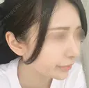 隆鼻術 / 鼻尖形成（切開） / 鼻中隔延長（切開） / 小鼻縮小（切開） / 軟骨移植 HANABI整形外科 DAY 85 サムネイル用