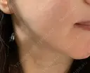 傷跡修正 / フラクショナルレーザー（毛穴・ニキビ跡） / YAGレーザー / その他（口元） 二子玉川ヤスダクリニック DAY 44 サムネイル用