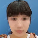 ボトックス（エラ・小顔） 湘南美容クリニック 静岡院 DAY 14 サムネイル用