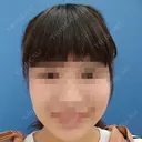 ボトックス（エラ・小顔） 湘南美容クリニック 静岡院 DAY 14 サムネイル用