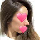 鼻中隔延長（切開） / 骨切幅寄せ / ワシ鼻修正・ハンプ切除 表参道スキンクリニック 表参道院 DAY 24 サムネイル用