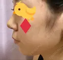 鼻尖形成（切開） / 小鼻縮小（切開） / ヒアルロン酸注入（あご） / ボトックス（エラ・小顔） / ヒアルロン酸注入（唇） / 毛穴洗浄（ハイドラフェイシャルなど） / その他（鼻） TCB東京中央美容外科 横浜院 DAY 4 サムネイル用
