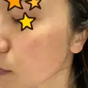 ピーリング（ニキビ・毛穴） / 美肌レーザー / フラクショナルレーザー（毛穴・ニキビ跡） PICO BEAUTY CLINIC DAY 0 サムネイル用