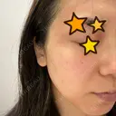 ピーリング（ニキビ・毛穴） / 美肌レーザー / フラクショナルレーザー（毛穴・ニキビ跡） PICO BEAUTY CLINIC DAY 0 サムネイル用