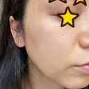 ピーリング（ニキビ・毛穴） / 美肌レーザー / フラクショナルレーザー（毛穴・ニキビ跡） PICO BEAUTY CLINIC DAY 1 サムネイル用