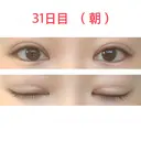 二重切開 水の森美容クリニック 東京新宿院 DAY 31 サムネイル用