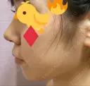 鼻尖形成（切開） / 小鼻縮小（切開） / ヒアルロン酸注入（あご） / ボトックス（エラ・小顔） / ヒアルロン酸注入（唇） / 毛穴洗浄（ハイドラフェイシャルなど） / その他（鼻） TCB東京中央美容外科 横浜院 AFTER サムネイル用
