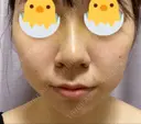 鼻尖形成（切開） / 小鼻縮小（切開） / ヒアルロン酸注入（あご） / ボトックス（エラ・小顔） / ヒアルロン酸注入（唇） / 毛穴洗浄（ハイドラフェイシャルなど） / その他（鼻） TCB東京中央美容外科 横浜院 DAY 5 サムネイル用