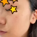 ピーリング（ニキビ・毛穴） / 美肌レーザー / フラクショナルレーザー（毛穴・ニキビ跡） PICO BEAUTY CLINIC DAY 2 サムネイル用
