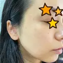 ピーリング（ニキビ・毛穴） / 美肌レーザー / フラクショナルレーザー（毛穴・ニキビ跡） PICO BEAUTY CLINIC DAY 2 サムネイル用