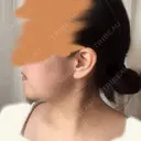 骨切り（あご） ボンディ美容整形外科（旧リオン整形外科） DAY 181 サムネイル用