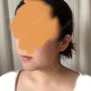 骨切り（あご） ボンディ美容整形外科（旧リオン整形外科） DAY 181 サムネイル用