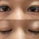 蒙古ひだ形成 / 目元修正 銀座高須クリニック AFTER サムネイル用