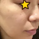 ピーリング（ニキビ・毛穴） / 美肌レーザー / フラクショナルレーザー（毛穴・ニキビ跡） PICO BEAUTY CLINIC AFTER サムネイル用