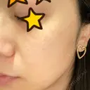 ピーリング（ニキビ・毛穴） / 美肌レーザー / フラクショナルレーザー（毛穴・ニキビ跡） PICO BEAUTY CLINIC DAY 4 サムネイル用