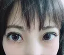 二重埋没 品川スキンクリニック沖縄院 AFTER サムネイル用
