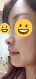 切開リフト GENIUS(ジーニアス)美容外科・皮膚科（旧：4ever美容外科・皮膚科 釜山 西面店） DAY 42 サムネイル用