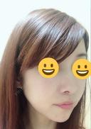 切開リフト GENIUS(ジーニアス)美容外科・皮膚科（旧：4ever美容外科・皮膚科 釜山 西面店） AFTER サムネイル用