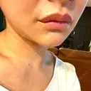 アートメイク（唇） BMC CLINIC 南青山 DAY 2 サムネイル用