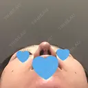 鼻尖形成（切開） / 軟骨移植 / 眉間プロテーゼ / 鼻尖縮小 湘南美容クリニック 柏院 DAY 25 サムネイル用