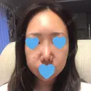 鼻尖形成（切開） / 軟骨移植 / 眉間プロテーゼ / 鼻尖縮小 湘南美容クリニック 柏院 DAY 25 サムネイル用