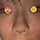 小鼻縮小（切開） / スレッドノーズ / ヒアルロン酸注入（鼻） キップン整形外科 DAY 3 サムネイル用