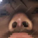 小鼻縮小（切開） / スレッドノーズ / ヒアルロン酸注入（鼻） キップン整形外科 DAY 3 サムネイル用