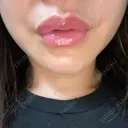 アートメイク（唇） BMC CLINIC 南青山 DAY 3 サムネイル用