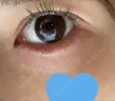 その他（目元） カリスクリニック DAY 6 サムネイル用