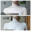 ボトックス（肩） もとび美容外科クリニック 新宿院 DAY 6 サムネイル用