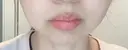 脂肪溶解注射（顔） 赤坂プレミアクリニック DAY 7 サムネイル用
