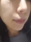 ニキビ治療 品川美容外科 仙台院 DAY 4 サムネイル用