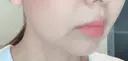 脂肪溶解注射（顔） 赤坂プレミアクリニック DAY 8 サムネイル用