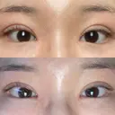 目頭切開 / 蒙古ひだ形成 / 目元修正 イブ整形外科 DAY 105 サムネイル用