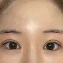 目頭切開 / 蒙古ひだ形成 / 目元修正 イブ整形外科 DAY 144 サムネイル用