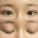 目頭切開 / 蒙古ひだ形成 / 目元修正 イブ整形外科 DAY 200 サムネイル用