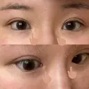 目頭切開 / 蒙古ひだ形成 / 目元修正 イブ整形外科 DAY 248 サムネイル用