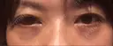 下まぶたの脂肪取り 水戸中央美容形成クリニック DAY 0 サムネイル用
