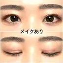 二重切開 / 上まぶたたるみ取り 広島プルミエクリニック DAY 91 サムネイル用