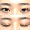二重切開 / 上まぶたたるみ取り 広島プルミエクリニック DAY 91 サムネイル用
