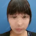 ボトックス（エラ・小顔） 湘南美容クリニック 静岡院 DAY 16 サムネイル用