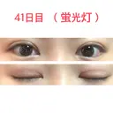 二重切開 水の森美容クリニック 東京新宿院 DAY 41 サムネイル用