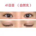 二重切開 水の森美容クリニック 東京新宿院 DAY 41 サムネイル用