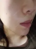 ニキビ治療 品川美容外科 仙台院 DAY 8 サムネイル用