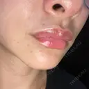アートメイク（唇） BMC CLINIC 南青山 DAY 10 サムネイル用