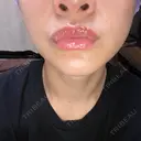 アートメイク（唇） BMC CLINIC 南青山 DAY 10 サムネイル用