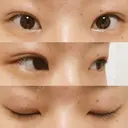 二重埋没 湘南美容クリニック 大阪堺東院 AFTER サムネイル用