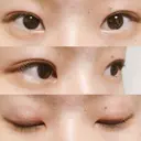 二重埋没 湘南美容クリニック 大阪堺東院 DAY 31 サムネイル用