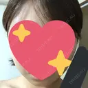 脂肪吸引（顔） / ボトックス（エラ・小顔） 銀座マイアミ美容外科 DAY 7 サムネイル用